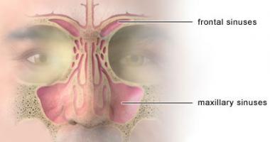 sinusitis