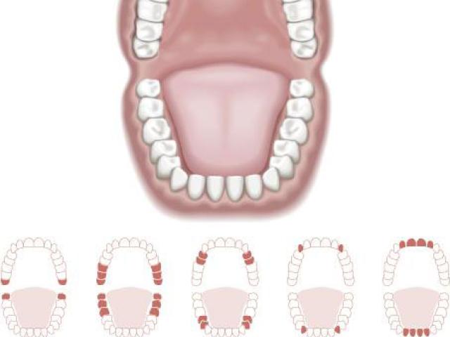 Muelas del juicio y resto de dientes en un diagrama de una boca