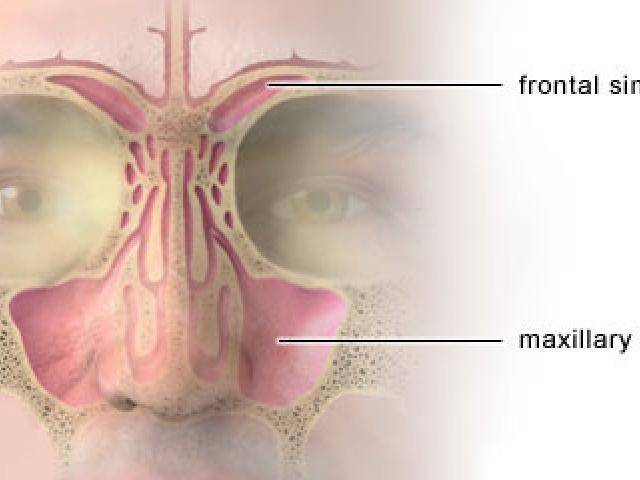 sinusitis