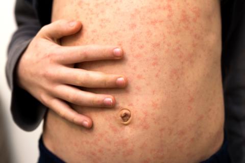 Ejemplo de sarpullido en un niño sin fiebre.